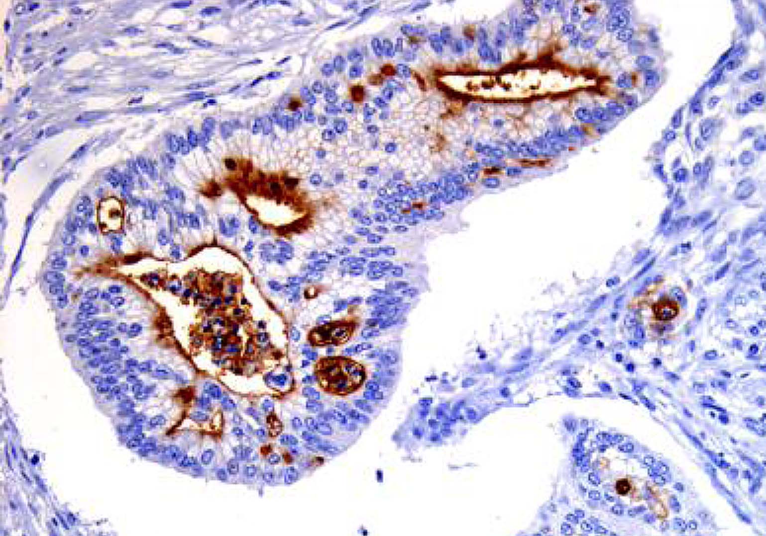 PANCREATIC CANCER Molecular Pathology Of Pancreatic Diseases